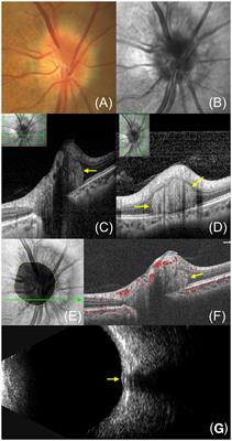 Peripapillary hyperreflective ovoid mass-like structures: multimodal imaging and associated diseases